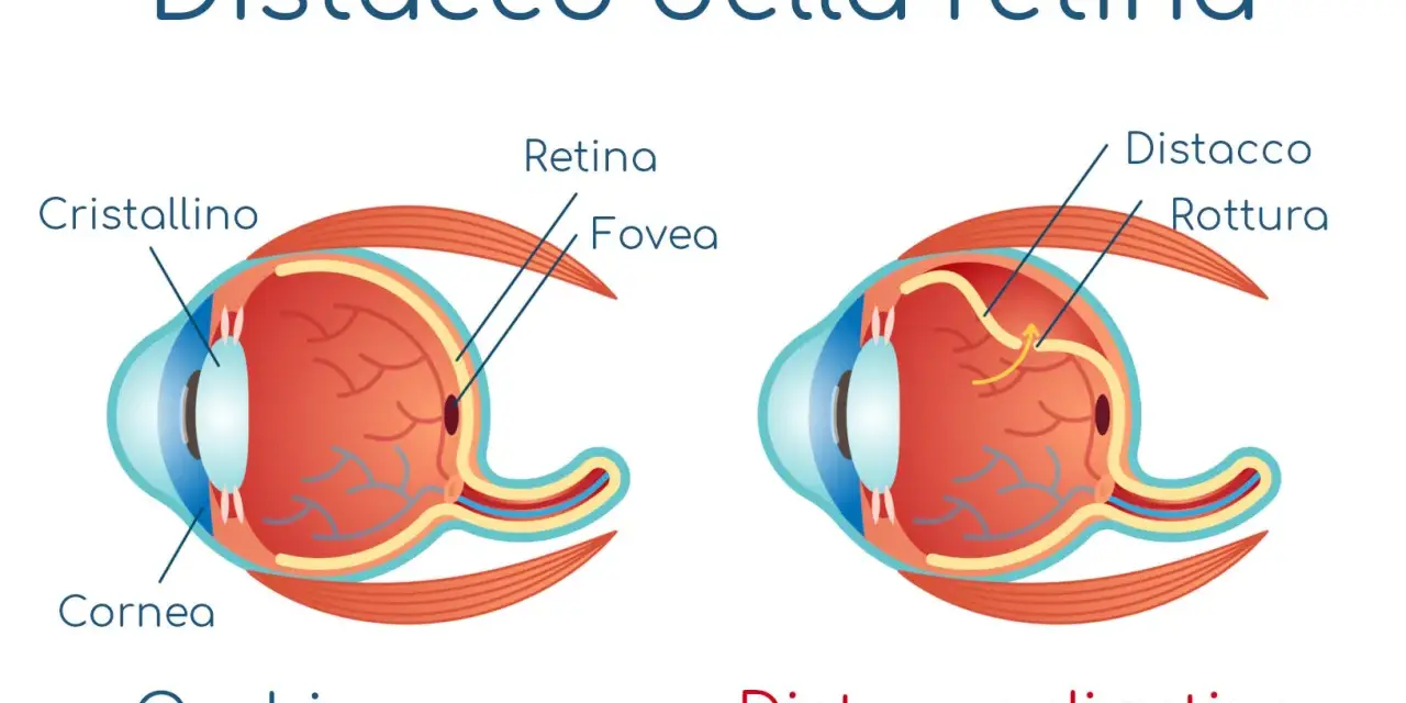 Confronto tra occhio sano e occhio con distacco della retina, mostrando la rottura e il sollevamento della retina.