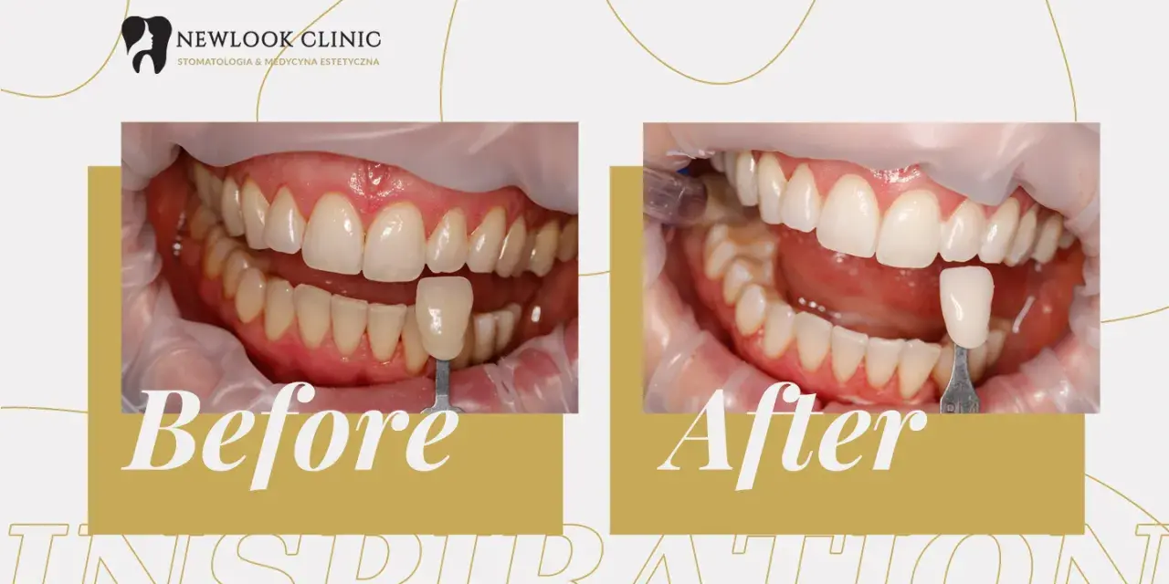 Przed i po wybielaniu zębów w New Look Clinic. Uśmiech jaśniejszy o kilka tonów!