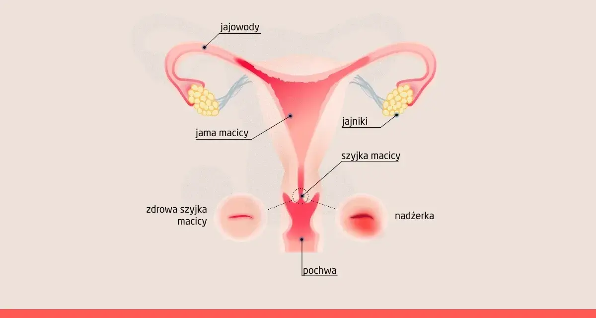 Ilustracja przedstawia budowę narządów rodnych kobiety z zaznaczoną nadżerką szyjki macicy. Obok zdrowej szyjki macicy widoczna jest nadżerka.