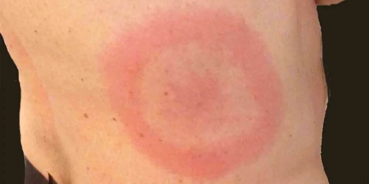 Hudutslag med rodnad och ringformad irritation, kan vara relaterat till klåda på kroppen klimakteriet.