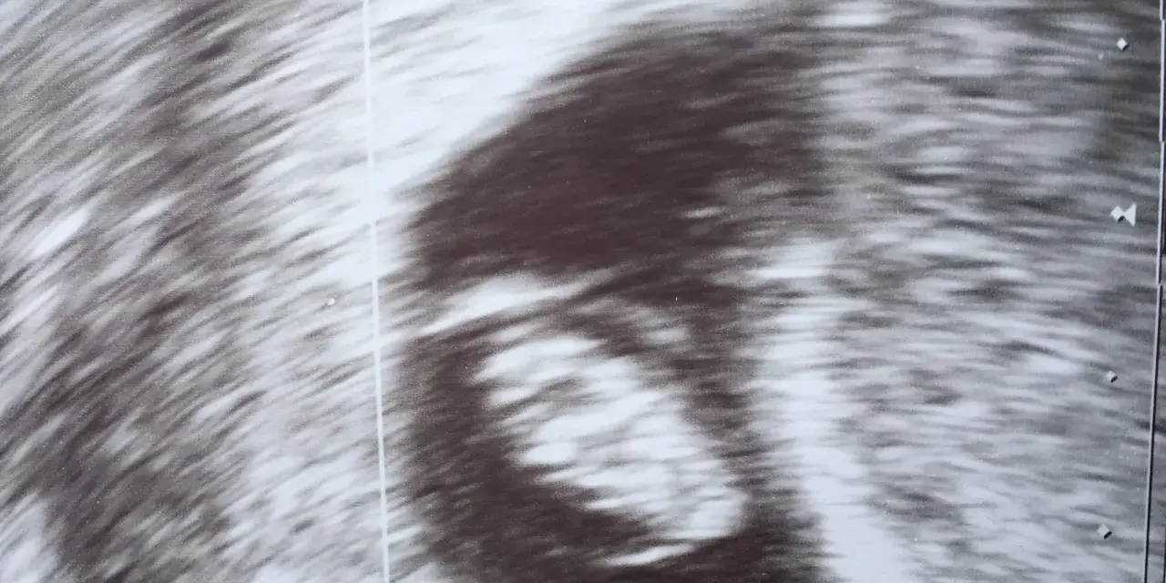 Ultraschallbild zeigt einen frühen Embryo. Die Ramzi-Methode könnte hier angewendet werden, um das Geschlecht zu erraten.