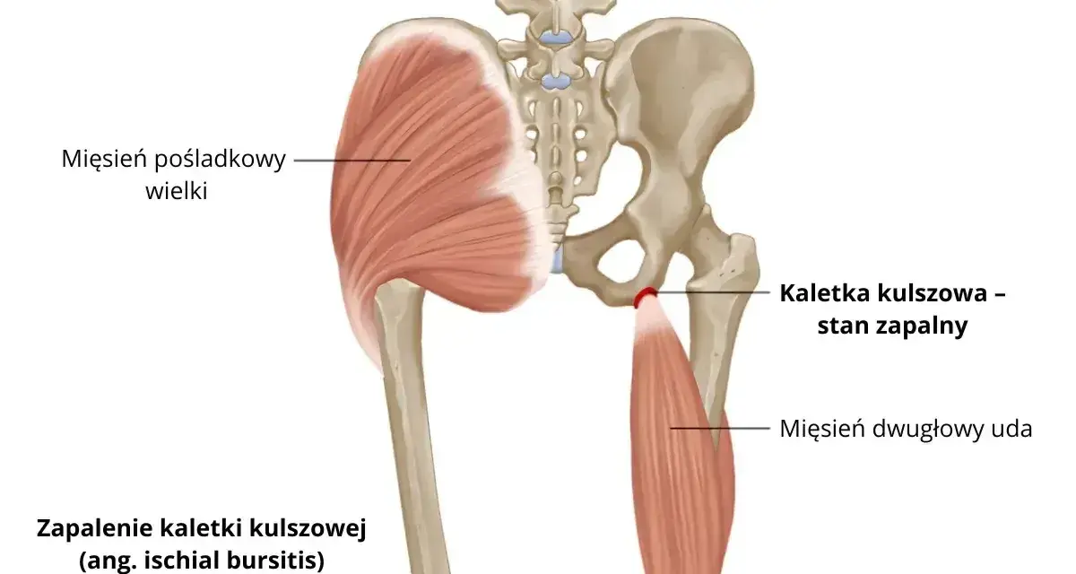 Zapalenie kaletki kulszowej, czyli stan zapalny w okolicy guza kulszowego, widoczny na tle miednicy i mięśni.