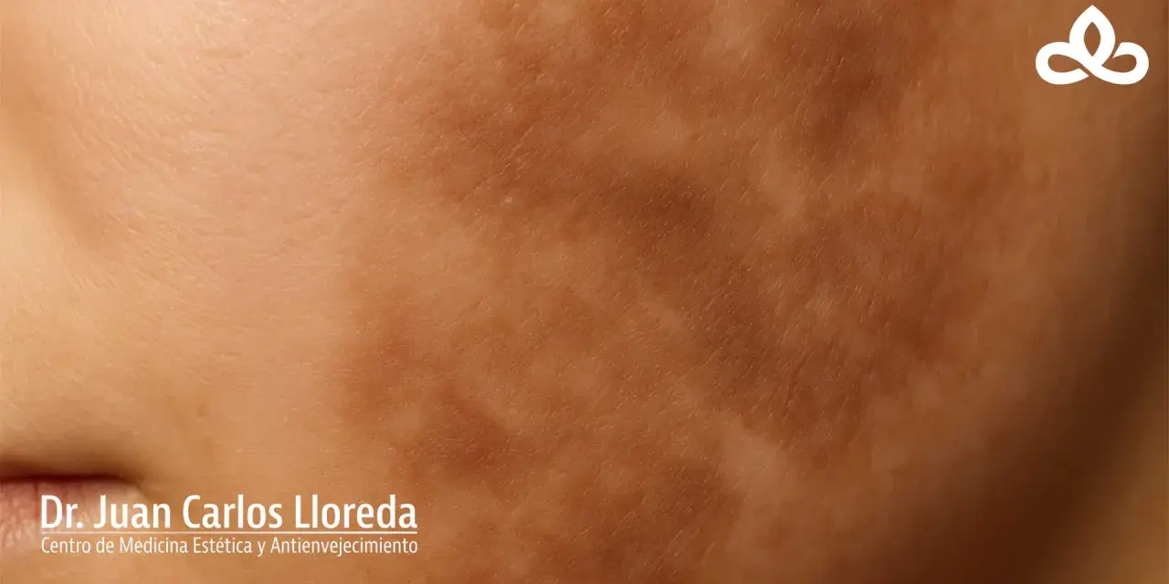 Piel con manchas irregulares, indicativo de hiperpigmentación postinflamatoria.