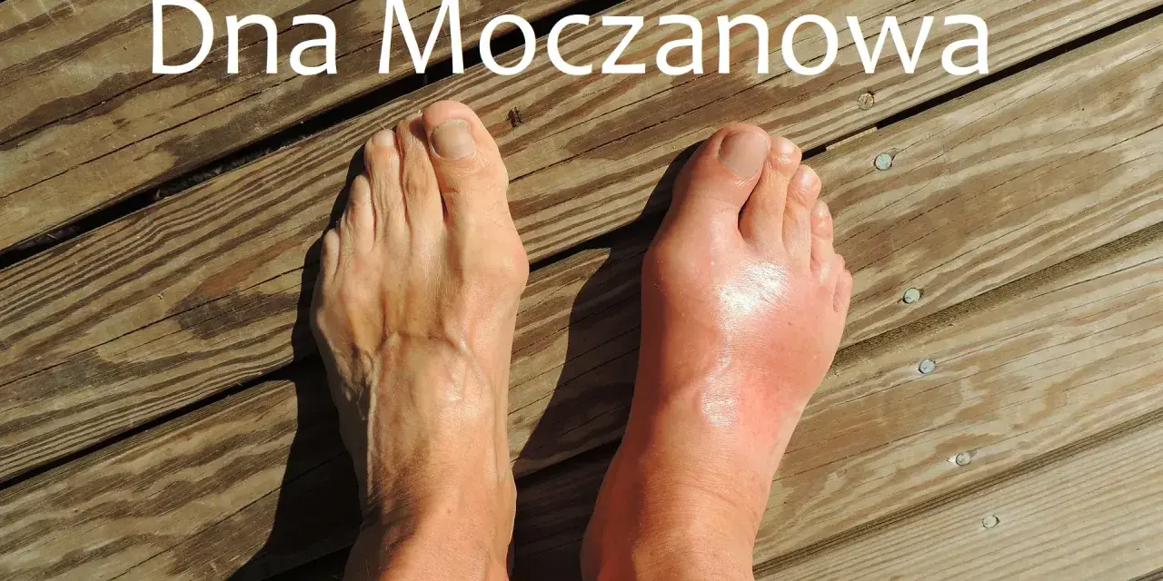 Dna moczanowa: obrzęknięty, czerwony paluch stopy po prawej, zdrowa stopa po lewej. Przyczyny tej choroby mogą być różne.