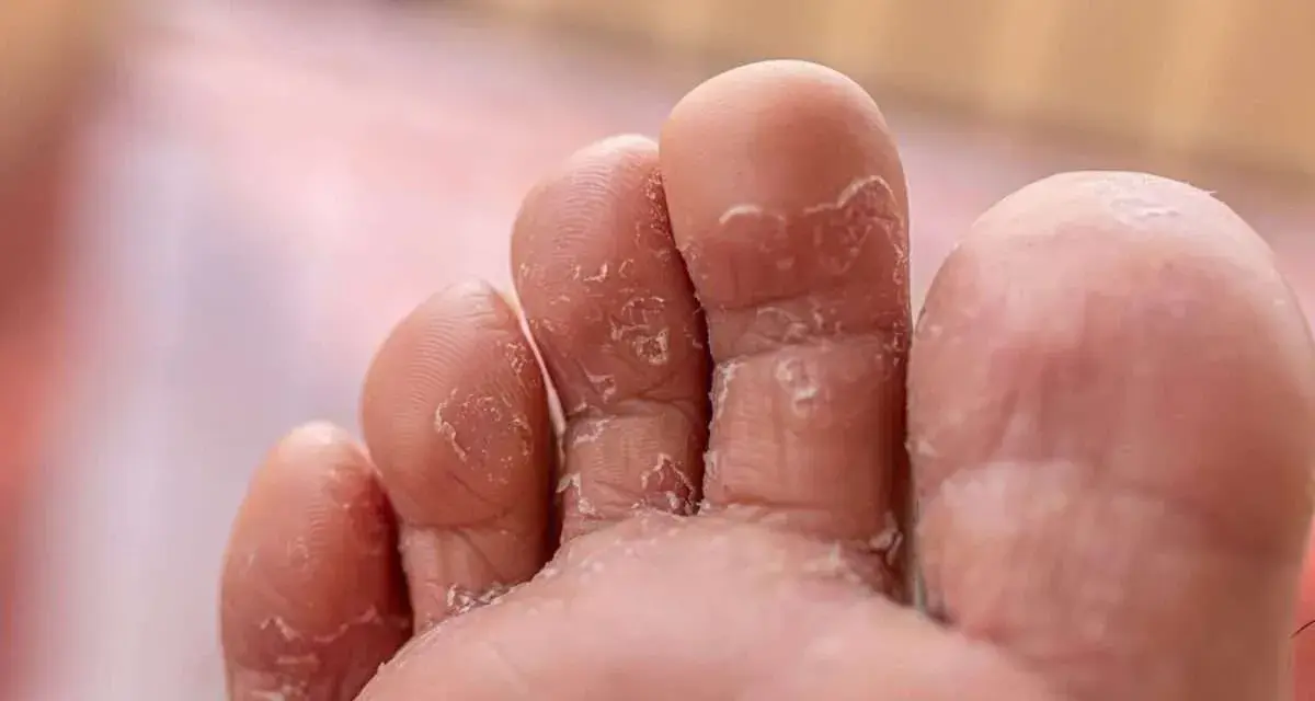 Close-up of toes with peeling skin, a common symptom of athlete's foot. Many wonder if Epsom salt is good for athlete's foot.