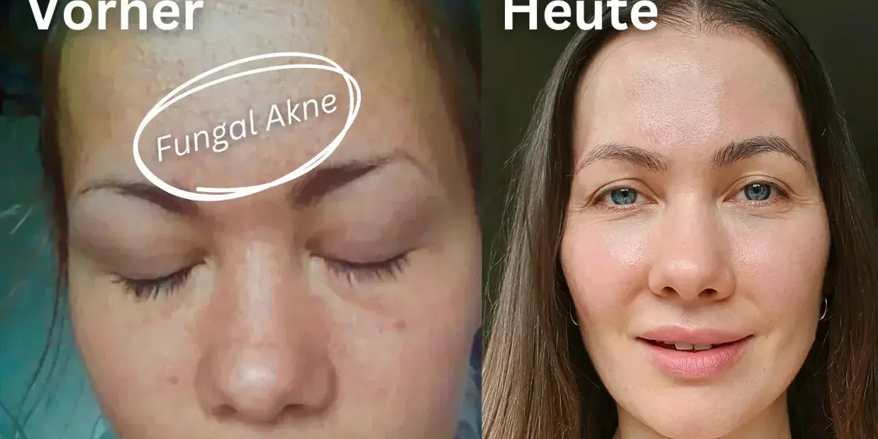 Vorher: Haut mit Rötungen und Pickelchen, gekennzeichnet als "Fungal Akne". Heute: Klare, strahlende Haut.