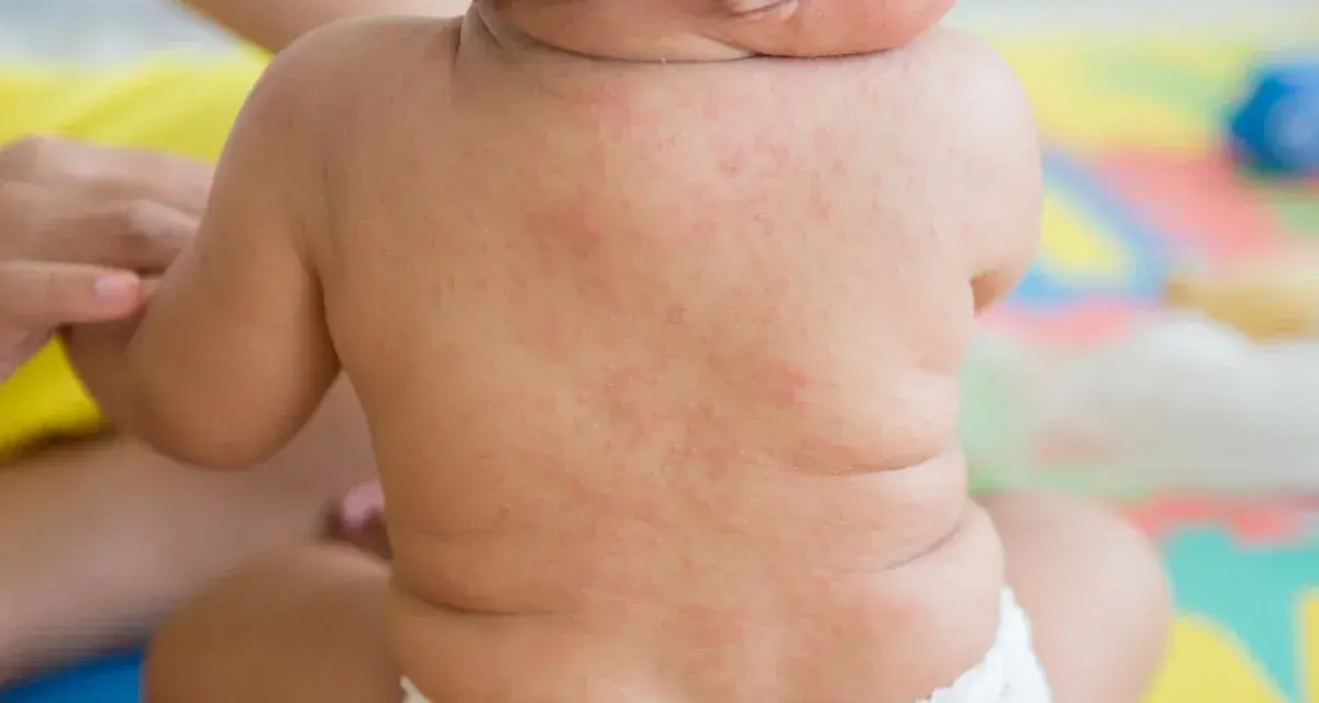 Roter Ausschlag auf dem Rücken eines Babys, möglicherweise nach drei Tagen Fieber.