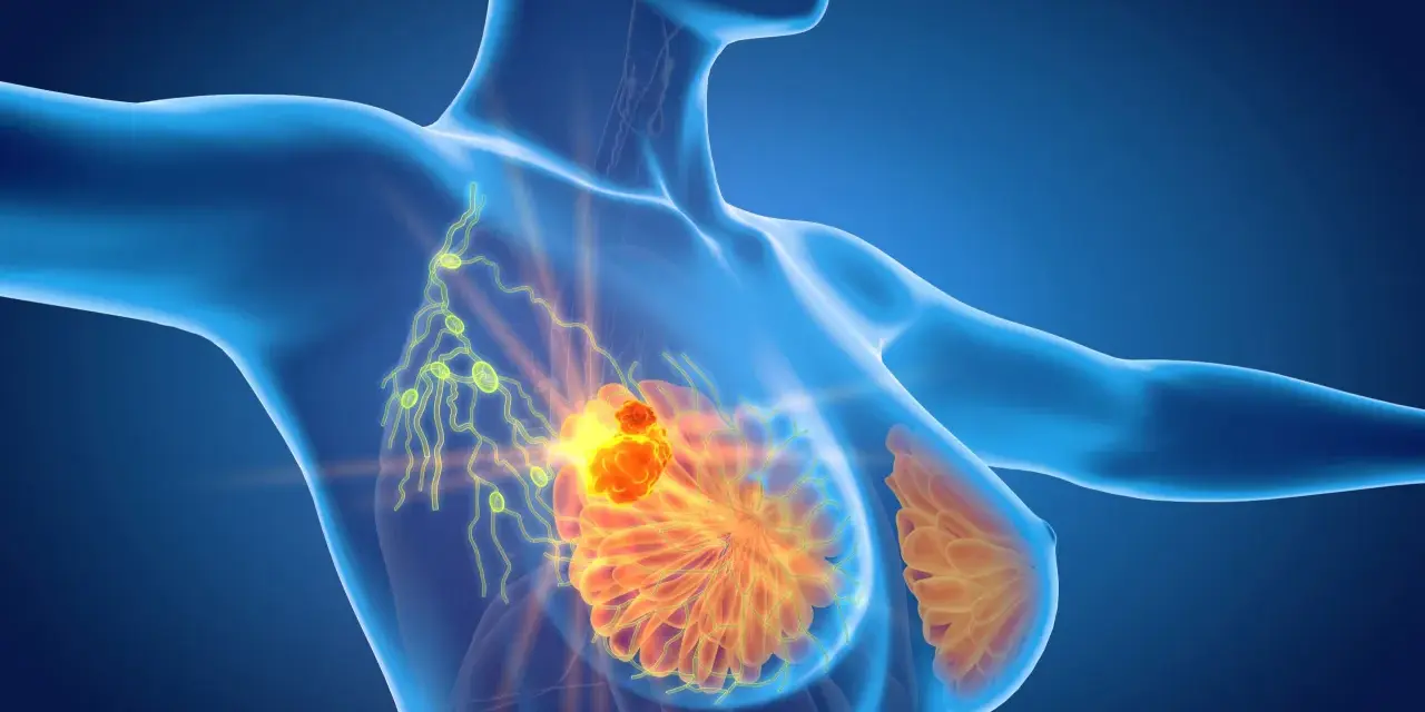 Anatomical illustration of a female torso showing breast tissue and lymph nodes, with a highlighted area indicating a potential issue.