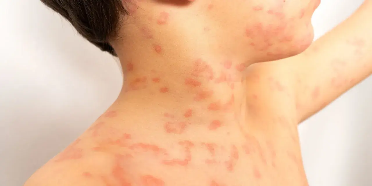 Primer plano de sarpullidos en la piel de un niño, con manchas rojas y elevadas en el cuello y el hombro.