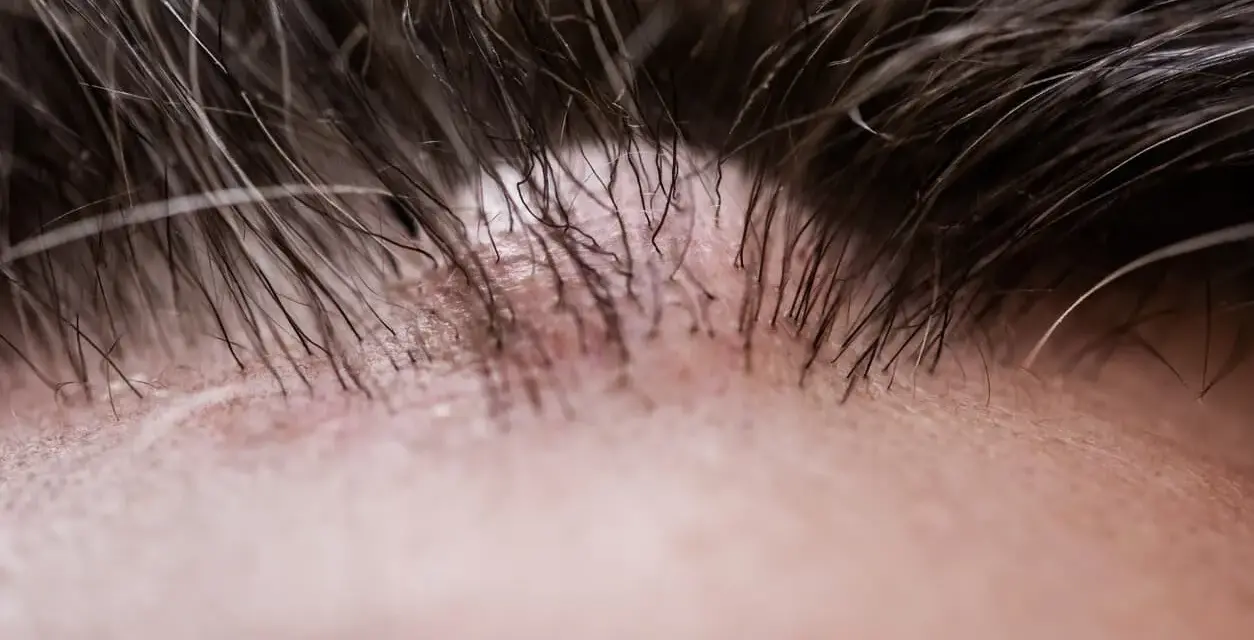 Primo piano della pelle con capelli scuri e una protuberanza sulla fronte, forse un brufolo o un piccolo neo.