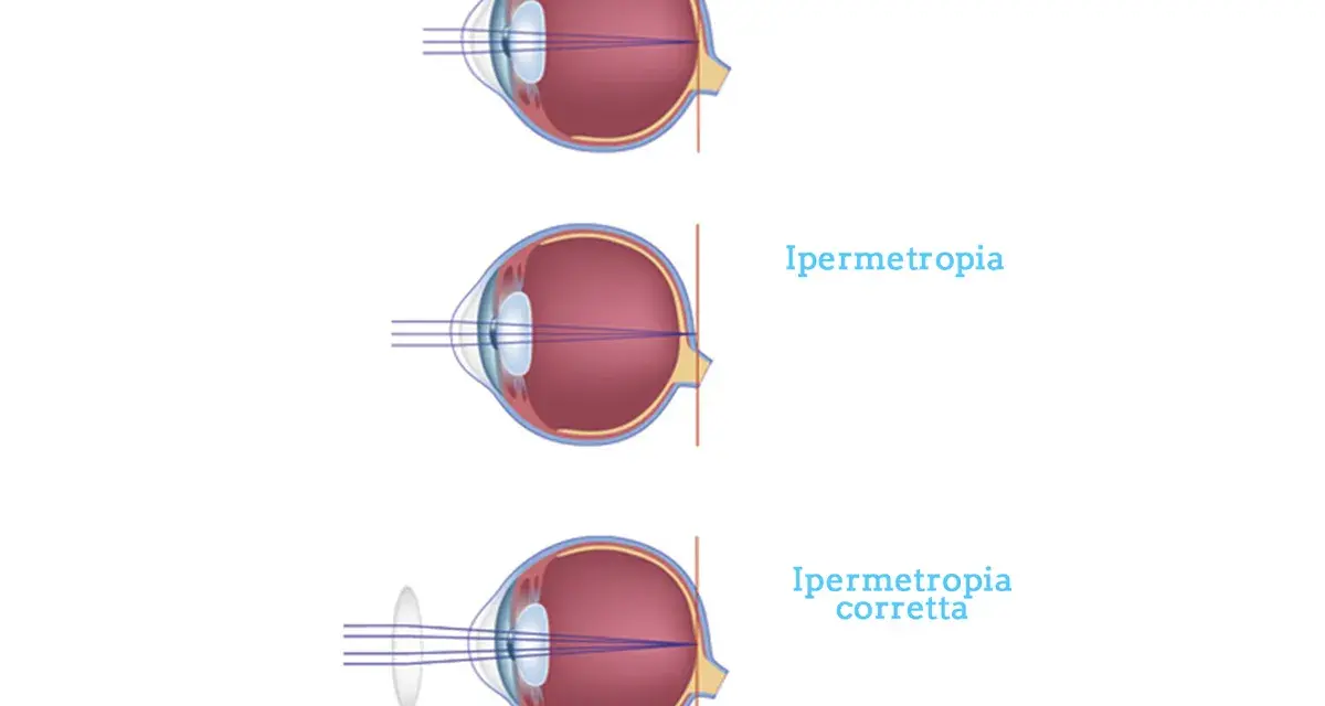 Illustrazione dell'ipermetropia oculare: visione normale, ipermetropia e correzione con lente.