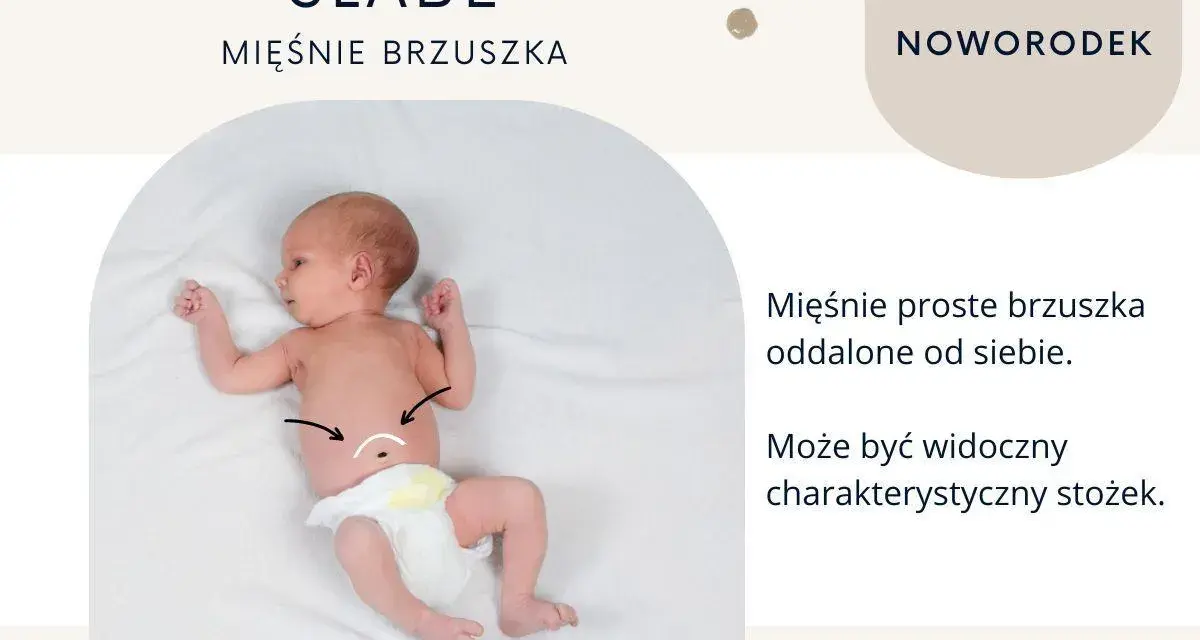Noworodek z widocznym, wzdętym brzuchem. Mięśnie proste brzuszka są oddalone, tworząc charakterystyczny stożek.