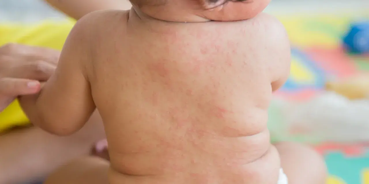 Plecy niemowlęcia pokryte drobną, czerwoną wysypką, przypominającą różyczkę. Mama martwi się o zdrowie maluszka.