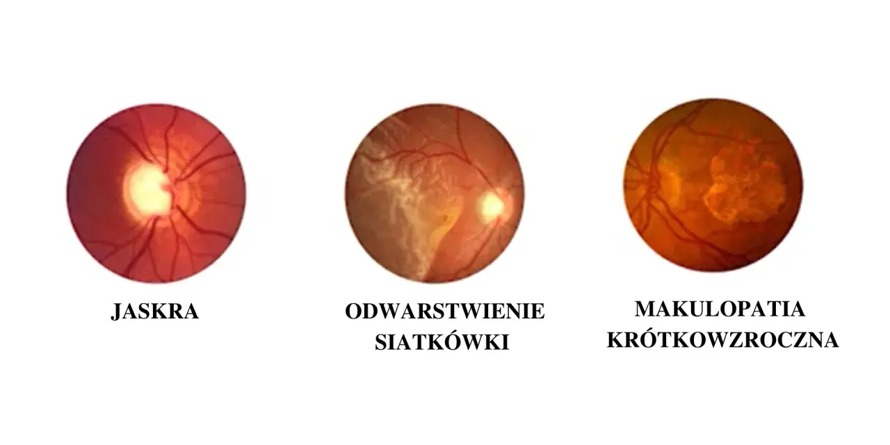 Krótkowzroczność: Jak zatrzymać postęp wady i odzyskać ostry wzrok?