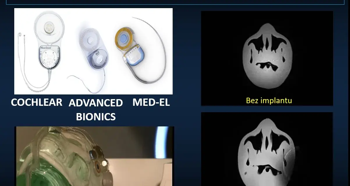 Nowoczesne implanty ślimakowe, w tym niewidoczny implant, poprawiają słuch.