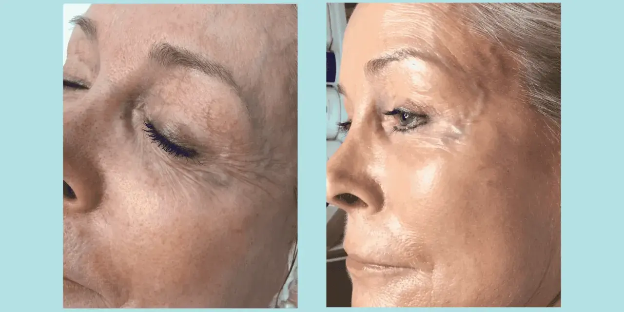 Before and after images show a woman's face. The "before" side displays dehydrated, dull skin with visible wrinkles. The "after" side reveals plump, hydrated, and radiant skin.
