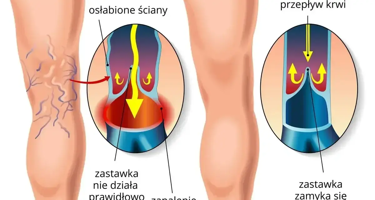 Ilustracja pokazuje nogę z żylakami i zdrową nogę. Flebolog wyjaśnia, że przy żylakach zastawki nie działają, powodując zapalenie.