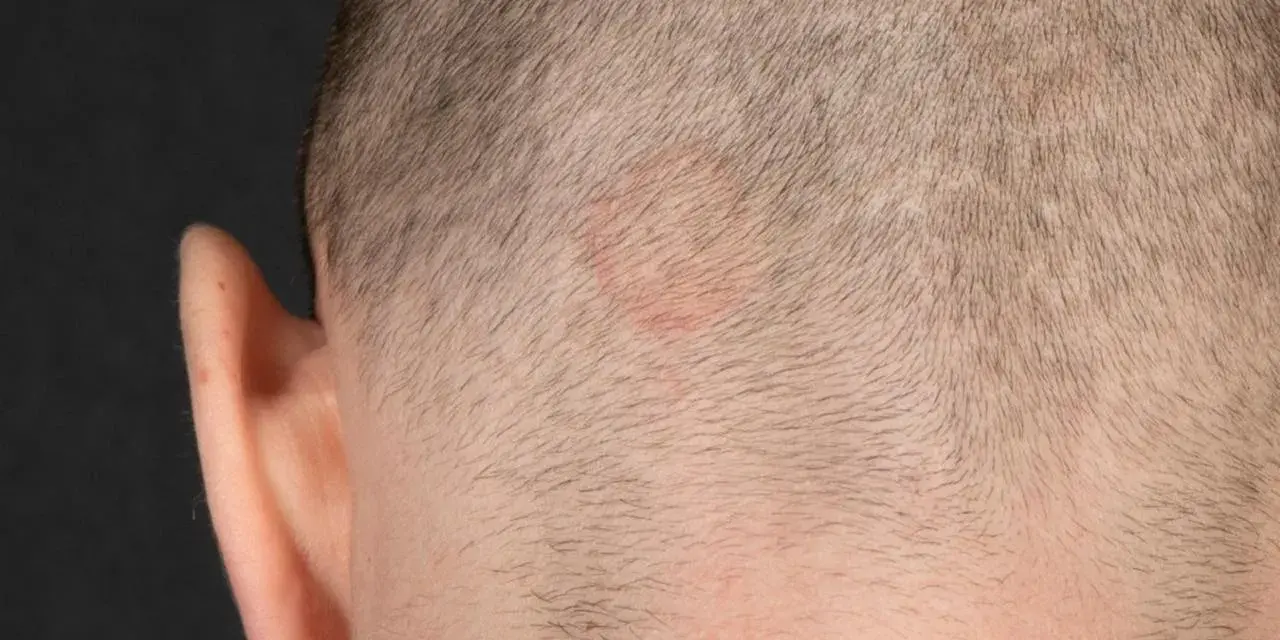Rötlicher, ringförmiger Hautausschlag am Kopf, möglicherweise tinea corporis.
