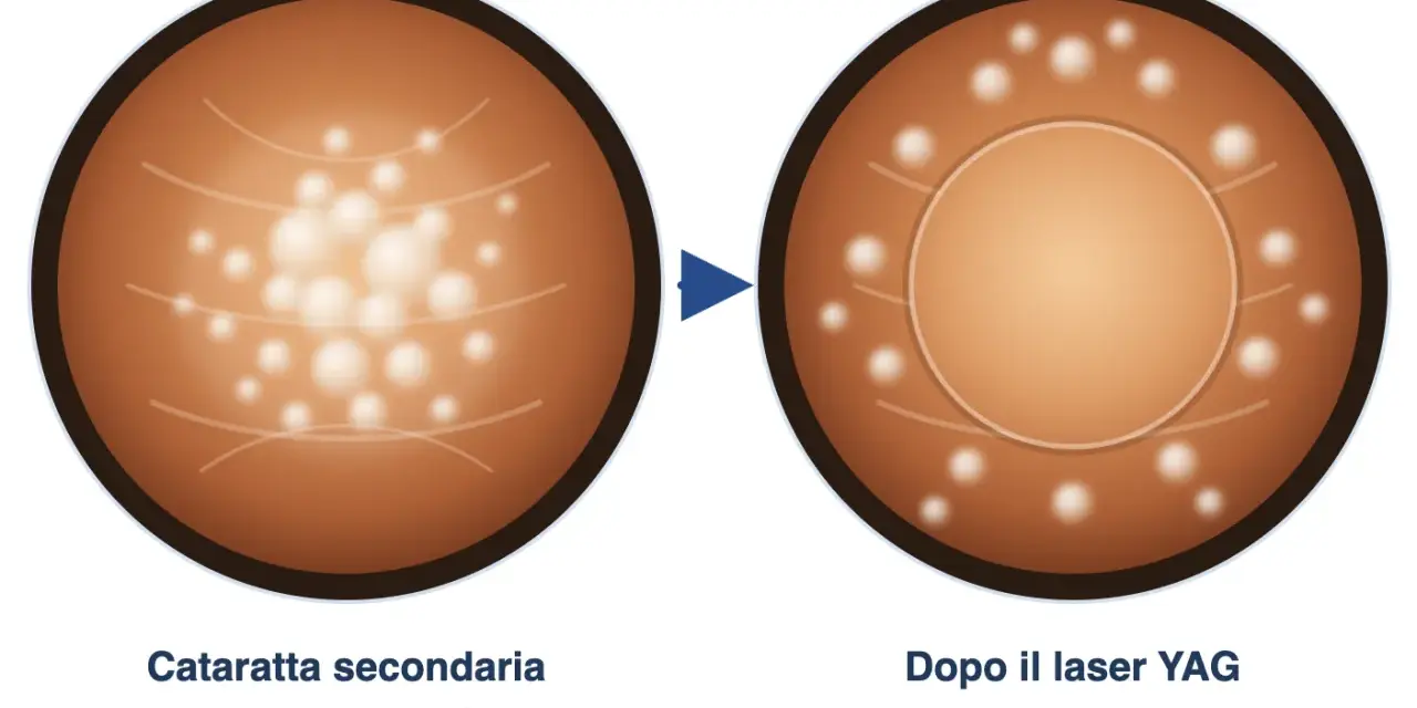 Prima e dopo il laser YAG: la capsula opacizzata della cataratta secondaria viene trattata con un barrage laser retina per ripristinare la visione nitida.