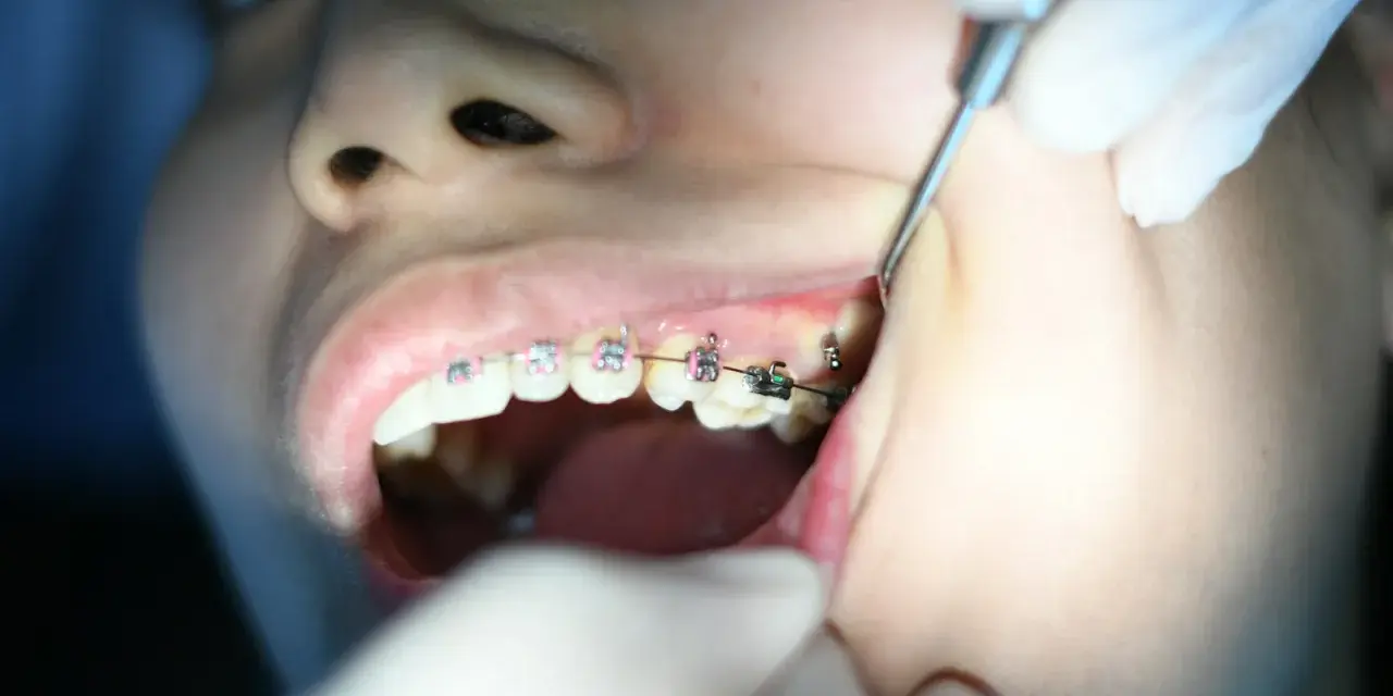 Aparat samoligaturujący wady zgryzu. Dentyści korygują zęby.