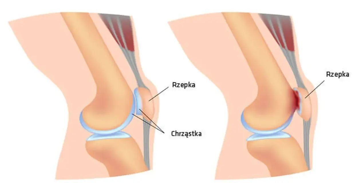 Porównanie zdrowego kolana z zaawansowaną chondromalacją 4 stopnia, gdzie chrząstka rzepki jest mocno uszkodzona.