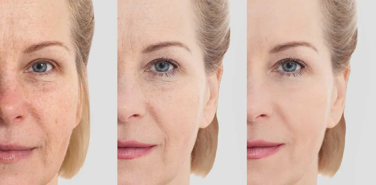 Comparaison avant/après : peau marquée par le temps, puis lissée grâce à l'acide hyaluronique sur le front et le visage.