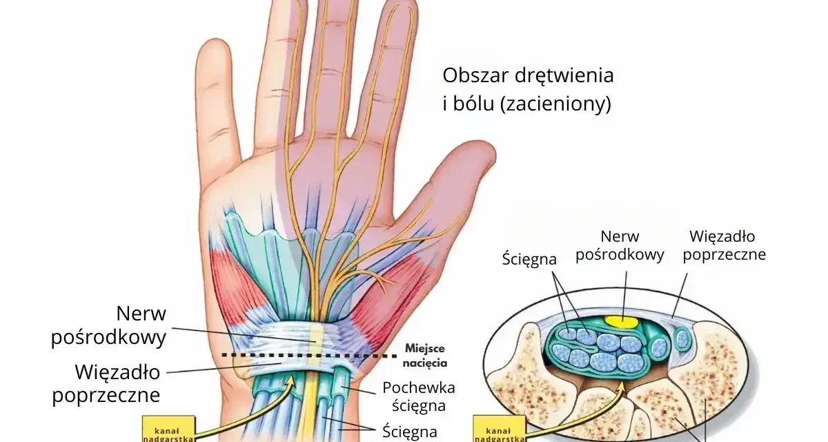 Anatomia dłoni ilustrująca ucisk na nerw pośrodkowy w kanale nadgarstka, powodujący drętwienie palców.