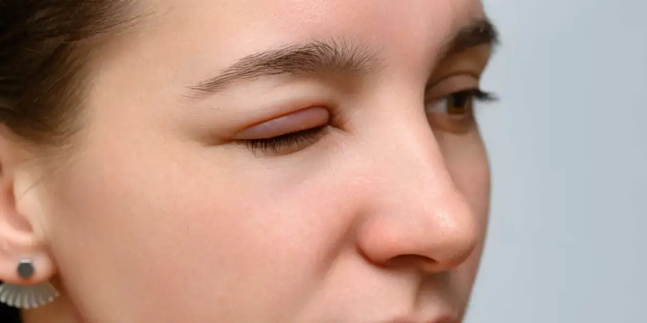 Occhi rossi e gonfi, forse per una reazione allergica. La palpebra è visibilmente gonfia e irritata.