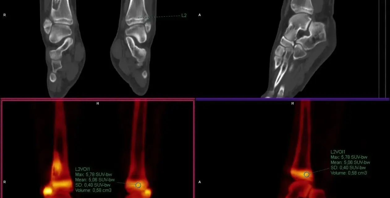 Co to jest SUV max i dlaczego jest kluczowy w diagnostyce medycznej