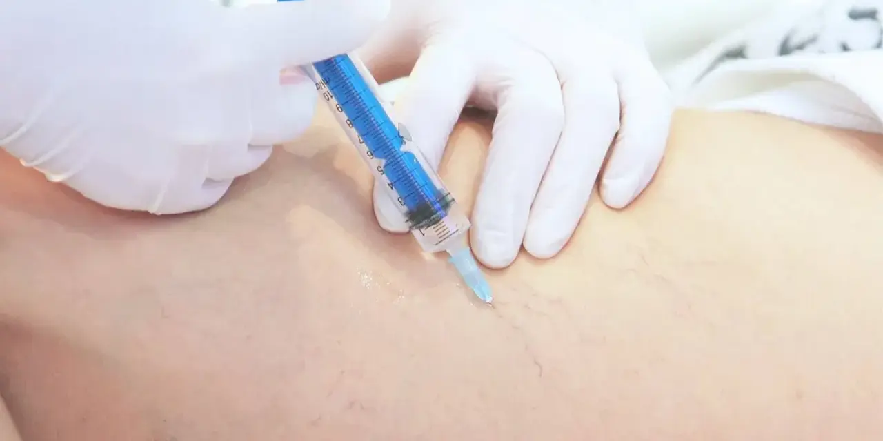Lekarz w białej rękawiczce wykonuje zastrzyk strzykawką w nogę z widocznymi naczynkami. To skleroterapia żylaków opinie.