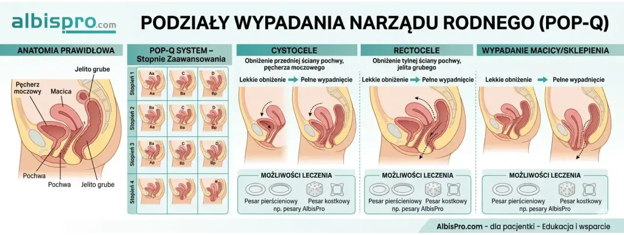 Ilustracja pokazuje wypadanie macicy i innych narządów miednicy mniejszej, z podziałem na stopnie zaawansowania i możliwości leczenia, np. pesary.