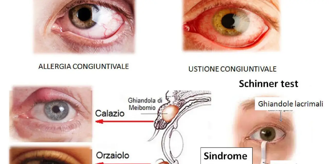 Occhio rosso che lacrima per allergia, ustione, calazio, orzaiolo e sindrome sicca. Test di Schirmer con carta da filtro.