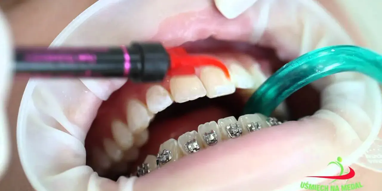 Aparat na zęby: jak się zakłada? Bez bólu, krok po kroku!