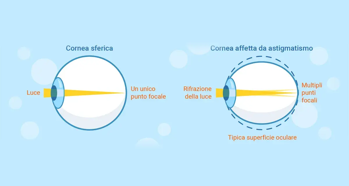 Diagramma mostra come vede un astigmatico: la luce si focalizza in più punti invece che in uno solo, creando una visione sfocata.