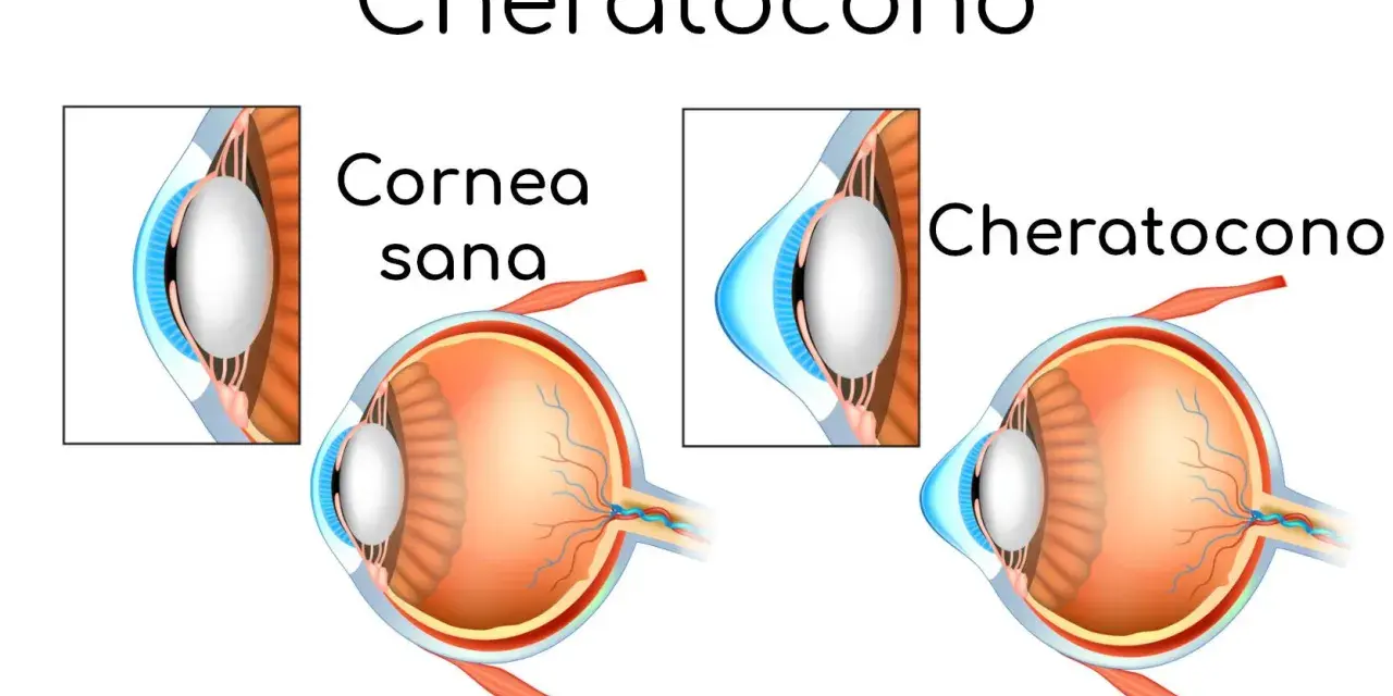 Confronto tra cornea sana e cheratocono: la vista di un occhio sano e uno affetto da cheratocono, che mostra la deformazione della cornea.