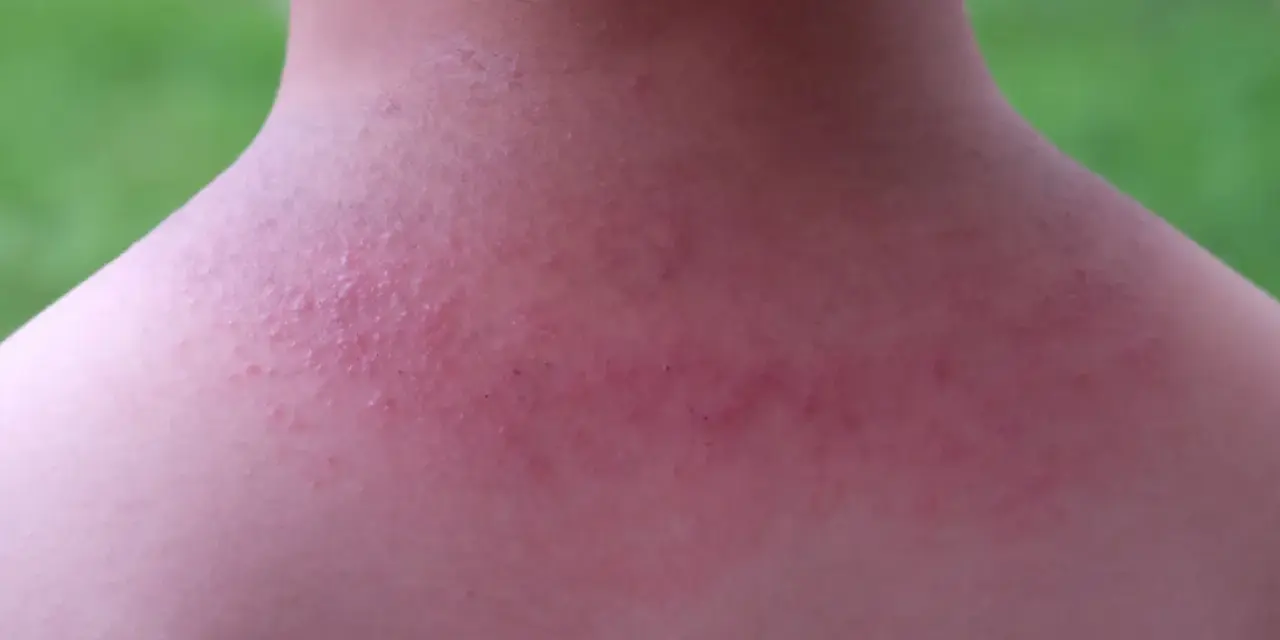Sarpullido en el cuello, con piel enrojecida y pequeños bultos.