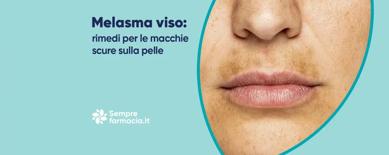 Primo piano del viso con macchie scure sopra il labbro, tipiche del melasma baffetti. Rimedi per le macchie scure sulla pelle.