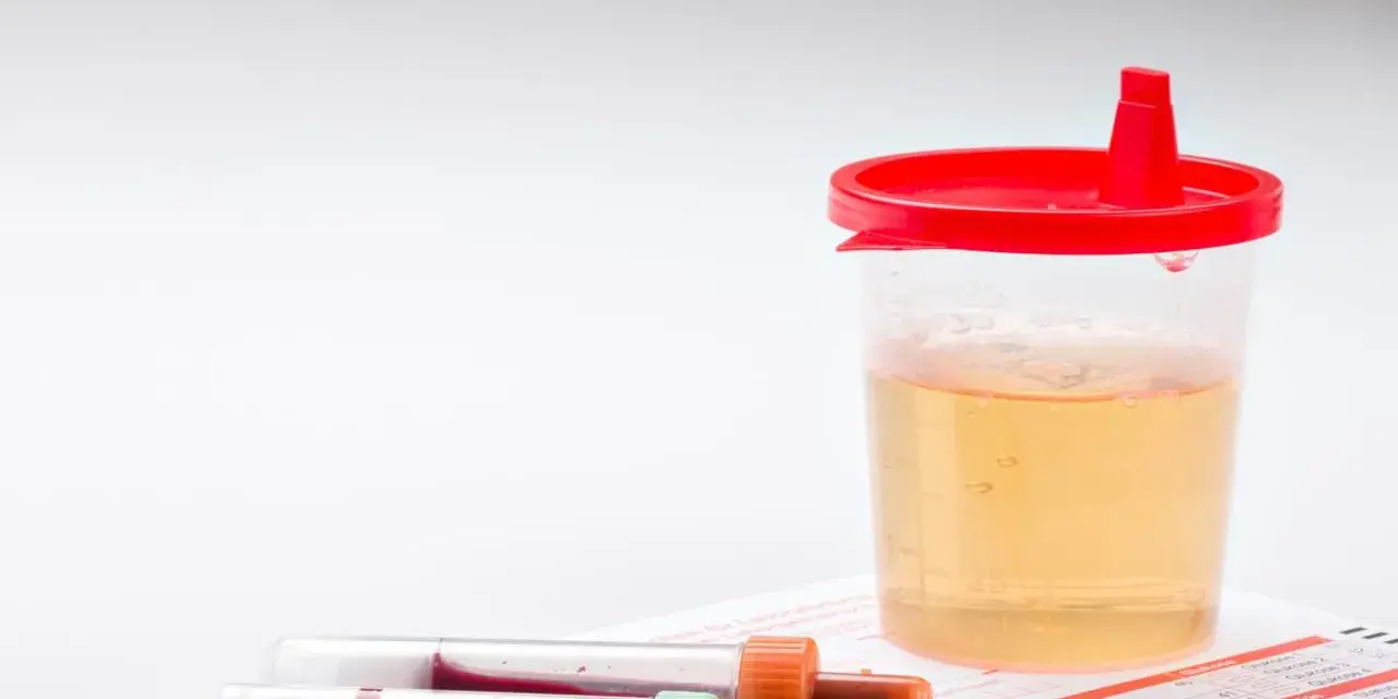 Pojemnik z żółtym płynem i próbówki z krwią. Wyniki badań wskazują na erytrocyty w moczu.