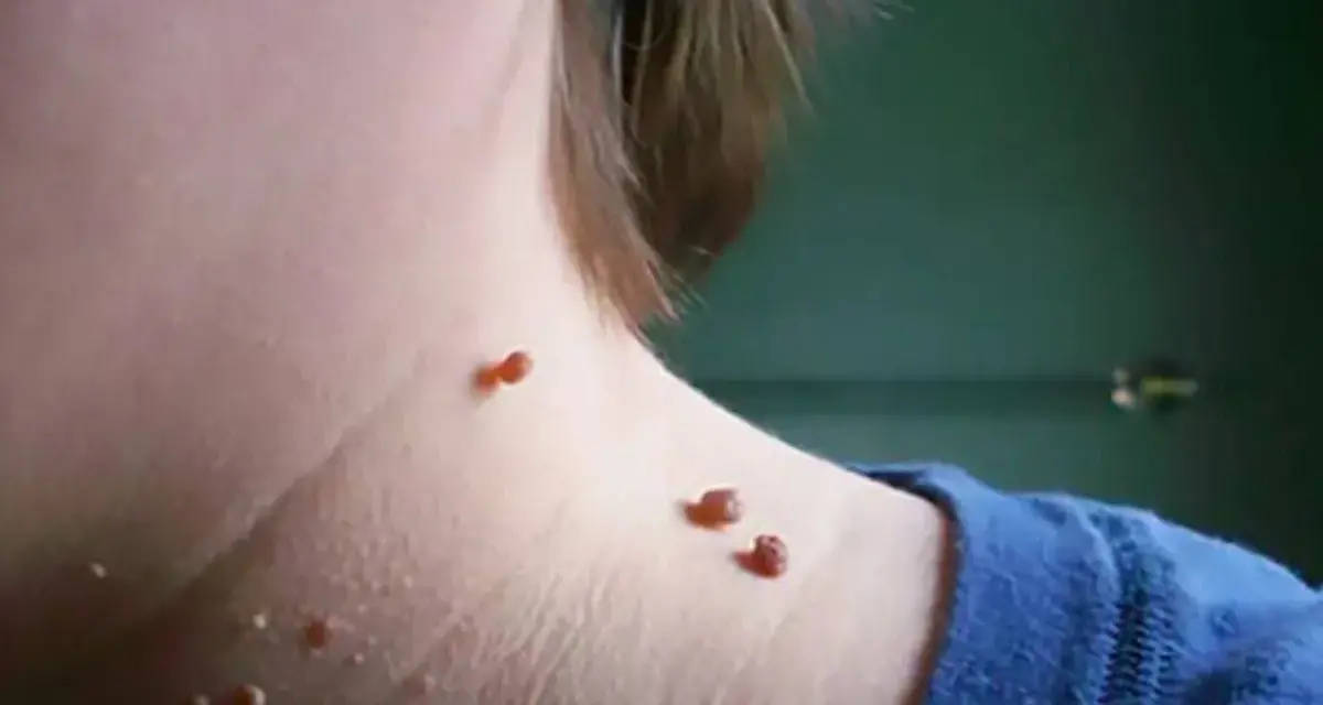 Piel con varias verrugas marrones y rojizas en el cuello, algunas agrupadas, sugiriendo la necesidad de quemar verrugas.