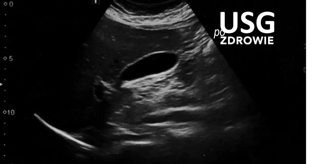 Obraz USG przedstawia pęcherzyk żółtkowy, ważny element układu trawiennego.