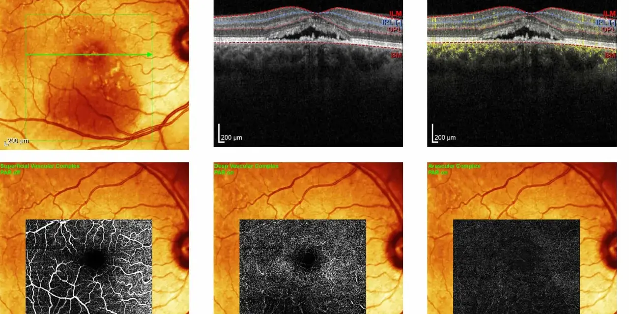 Immagini OCT e IR di un occhio con segni di retinopatia da stress, mostrando alterazioni vascolari e strutturali.