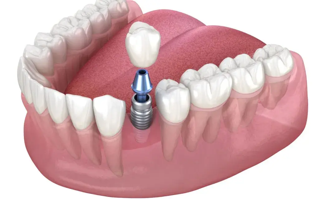 Brak piątki? Ile kosztuje implant, most, proteza? Porównanie cen