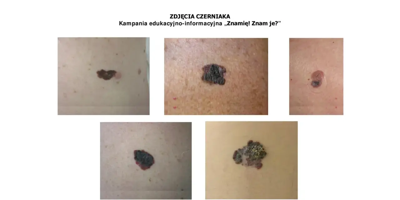 Zbliżenia różnych znamion i czerniaków na skórze.