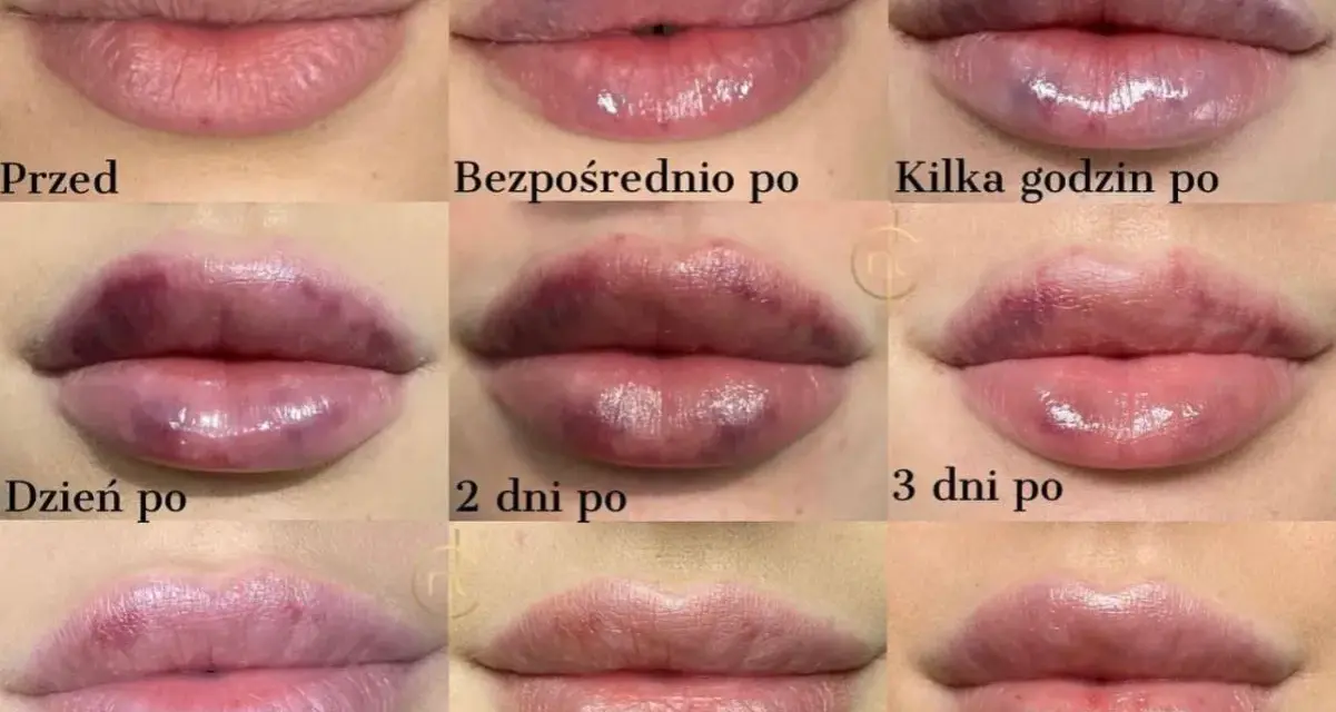 Jak bezpiecznie spać po powiększaniu ust? Porady eksperta