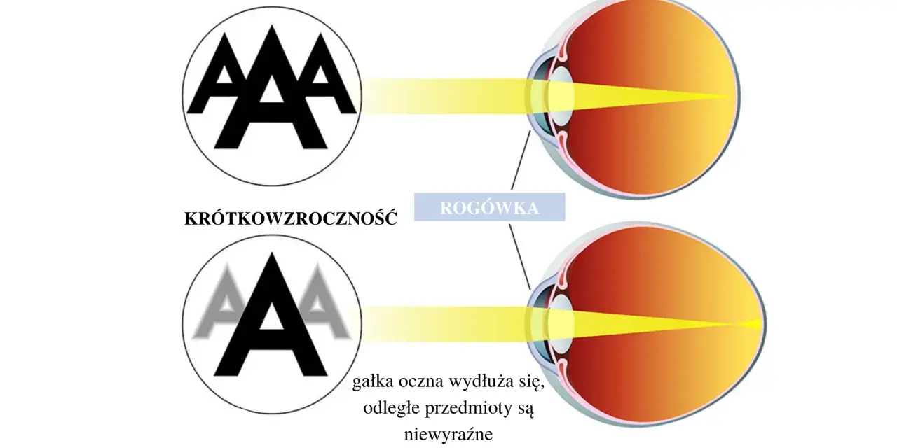 Progresja wady wzroku: Zrozum przyczyny i skutecznie ją spowolnij