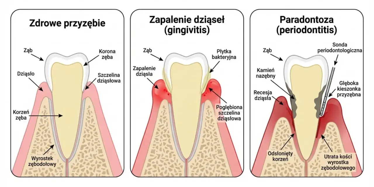 Ilustracja pokazuje postęp chorób przyzębia: zdrowe dziąsła, zapalenie dziąseł i paradontozę. Czy paradontoza jest zaraźliwa?