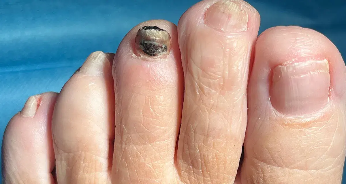 Ein Zeh mit einem dunklen bluterguss unter zehennagel. Der Nagel ist stark beschädigt und dunkel verfärbt.