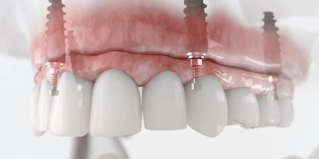 Model szczęki z implantami. Podniesienie dna zatoki szczękowej cena zabiegu jest kluczowa dla stabilności implantów.