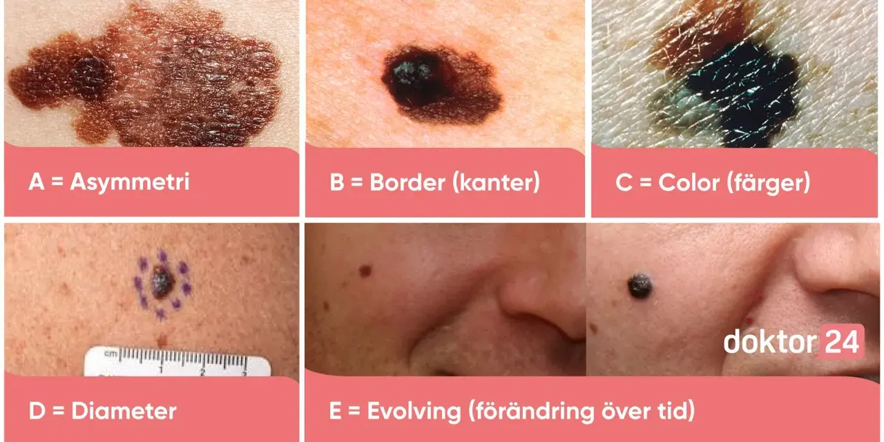 Sex bilder visar olika hudförändringar, A-E, för att bedöma abcde hud.