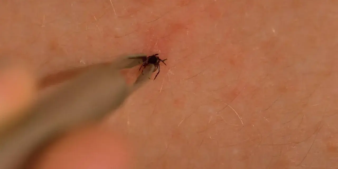 Jak bezpiecznie usunąć kleszcza? Sprawdź instrukcję krok po kroku